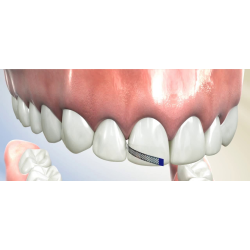 ULTRADENT Jiffy Proximal Saw 6mm 10ks