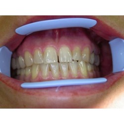 Kerr OptiView Kit Rozvěrač Úst Standard 2 ks